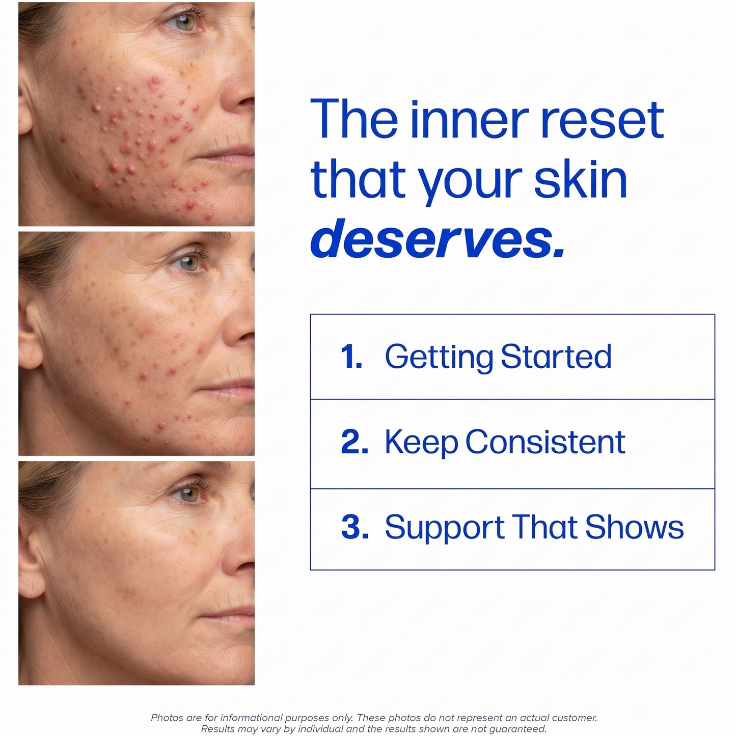 Women’s Hormonal Acne Support