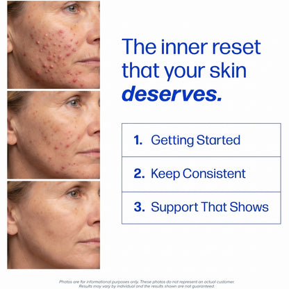Women’s Hormonal Acne Support
