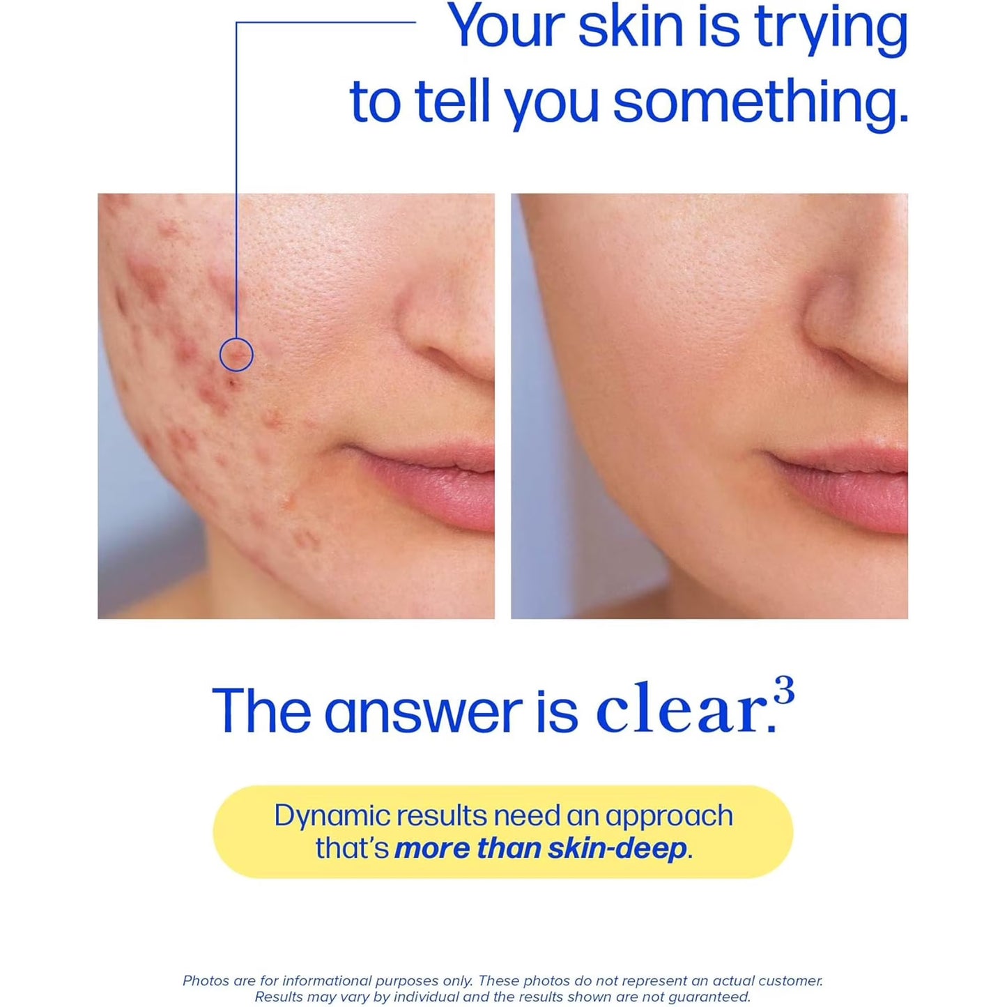Women’s Hormonal Acne Support